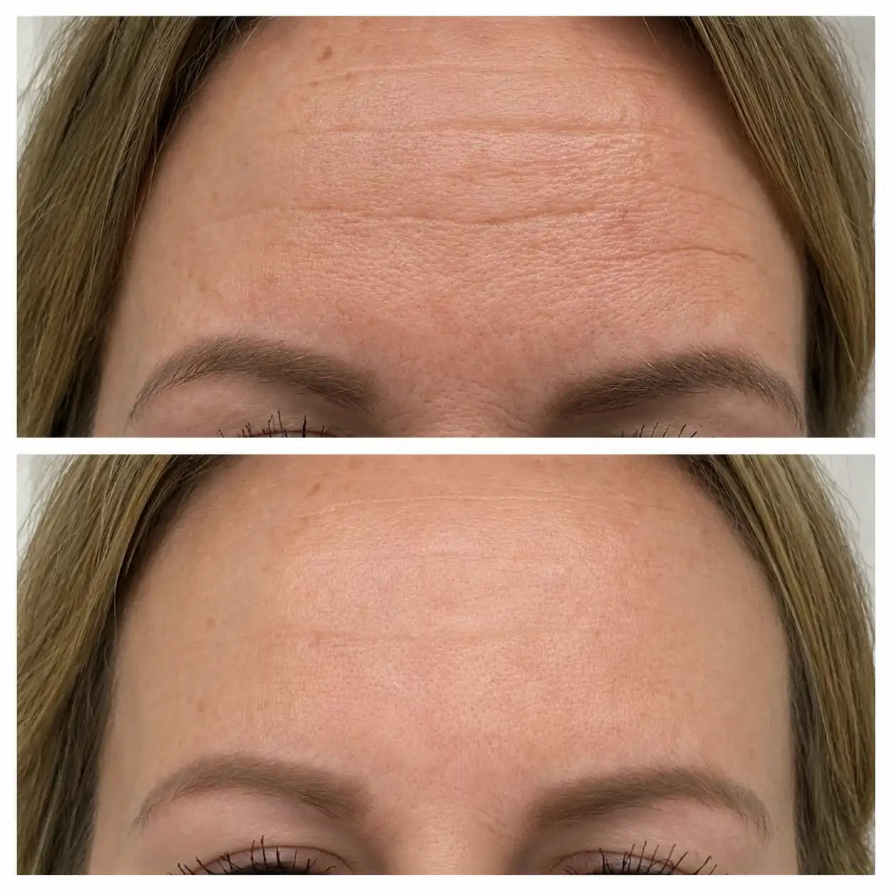 rf microneedling devices