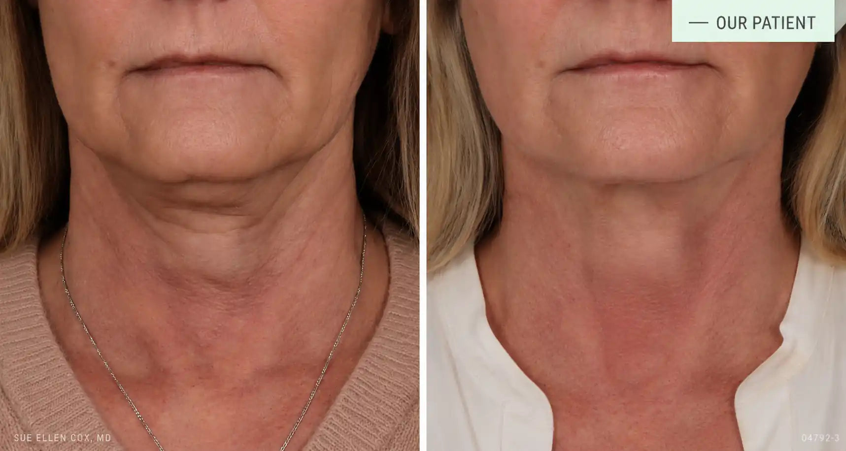 rf microneedling devices