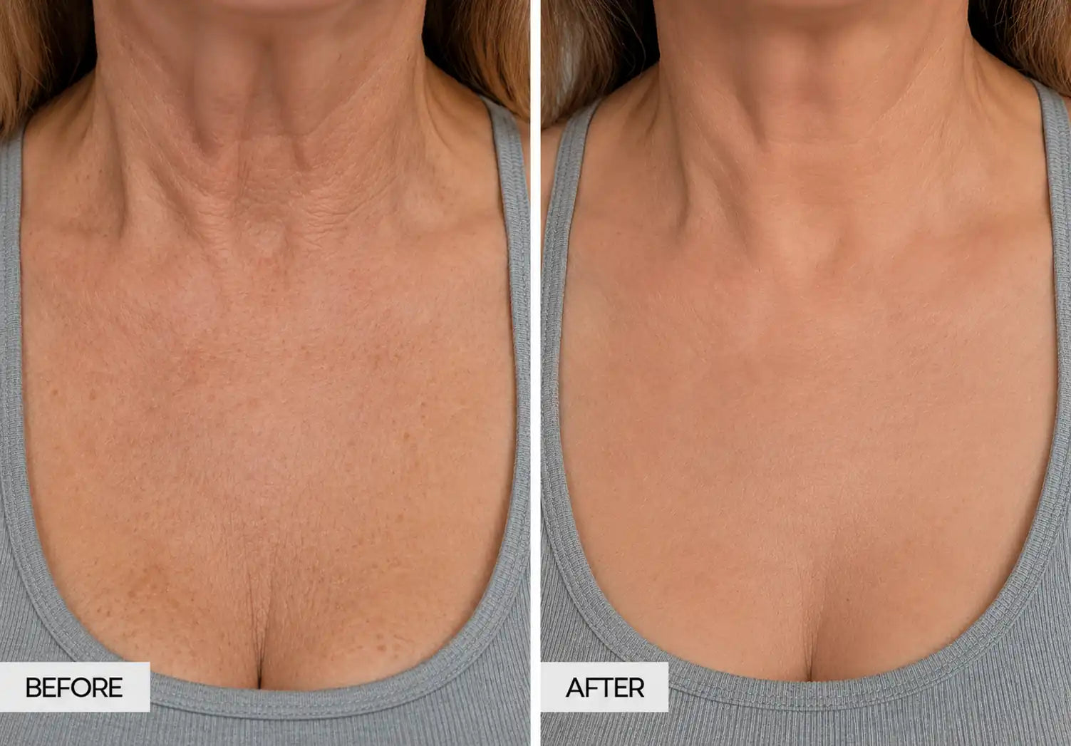 rf microneedling devices