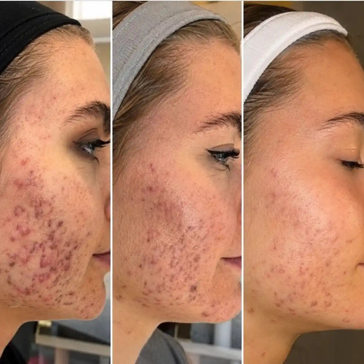 rf microneedling devices