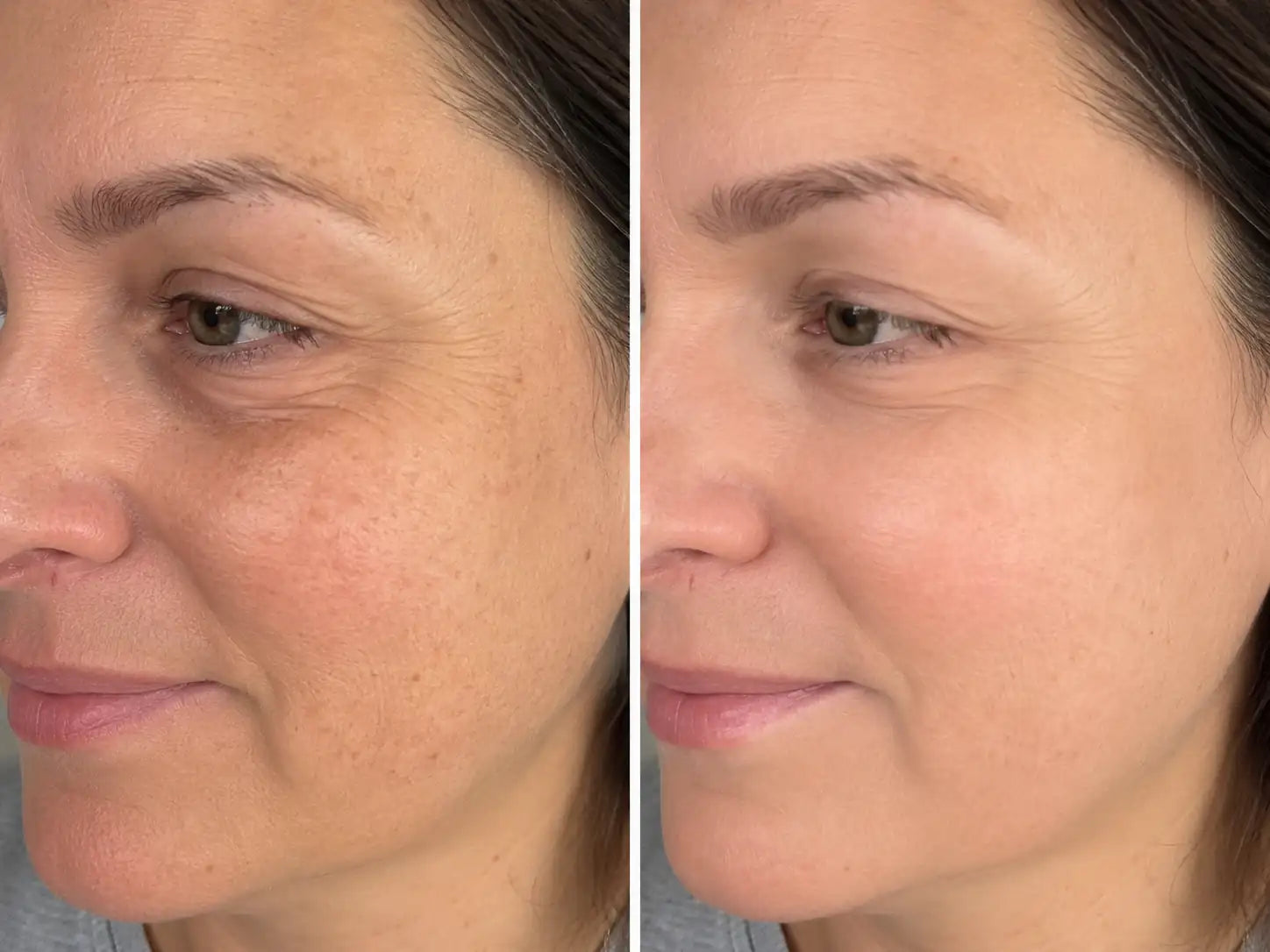 rf microneedling devices