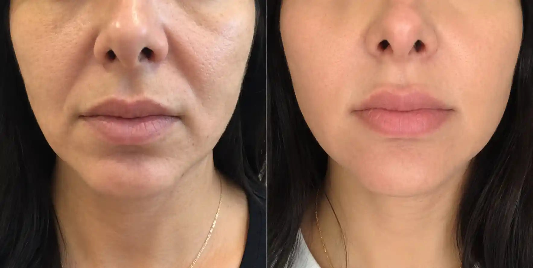 skin tightening machine